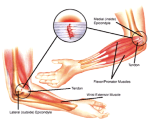 Tennis Elbow